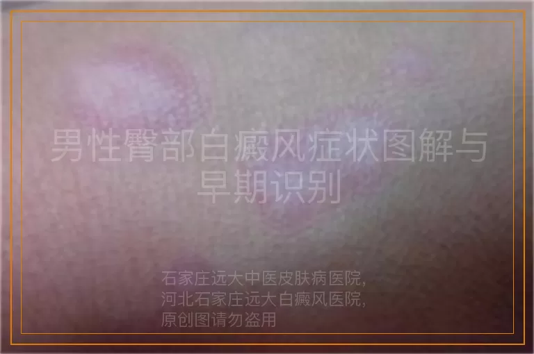 男性臀部白癜风症状图解与早期识别