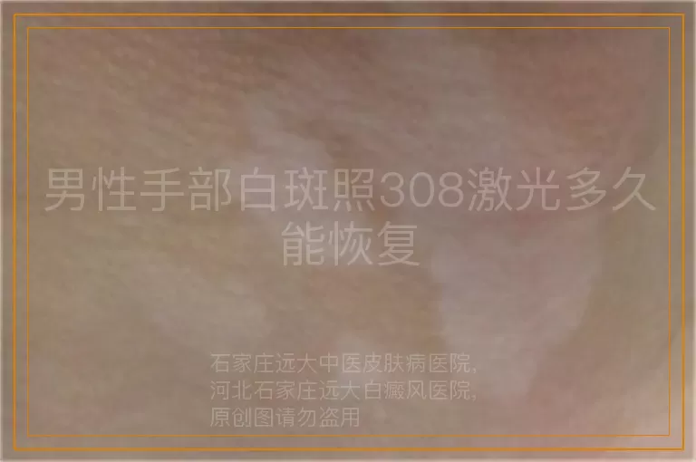 男性手部白斑照308激光多久能恢复