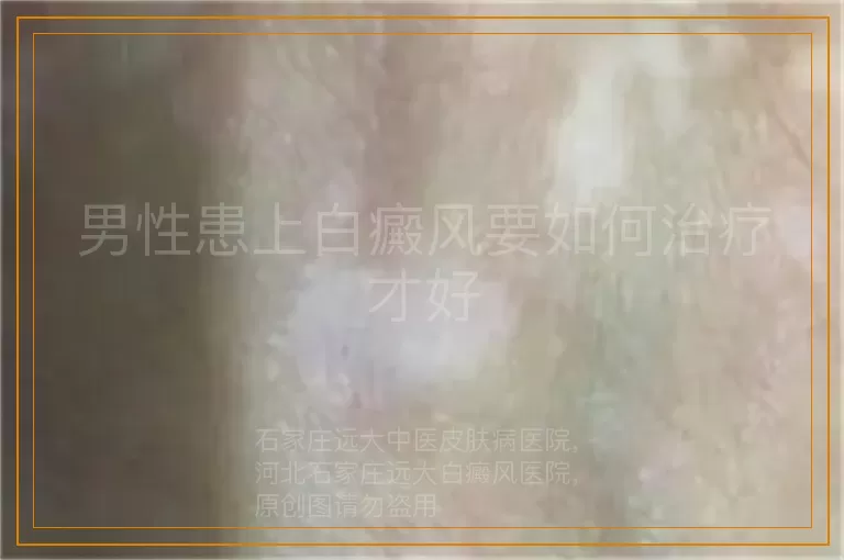 男性患上白癜风要如何治疗才好