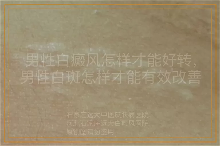男性白癜风怎样才能好转，男性白斑怎样才能有效改善，男性白癜风怎样才能慢慢恢复