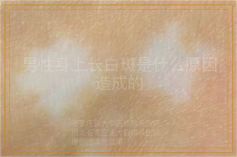 男性身上长白斑是什么原因造成的