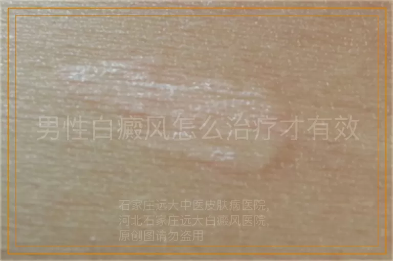 男性白癜风怎么治疗才有效
