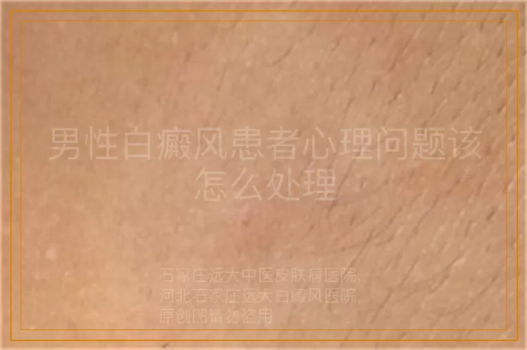 男性白癜风患者心理问题该怎么处理