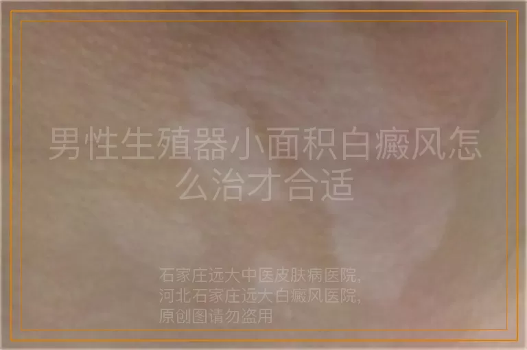 男性生殖器小面积白癜风怎么治才合适
