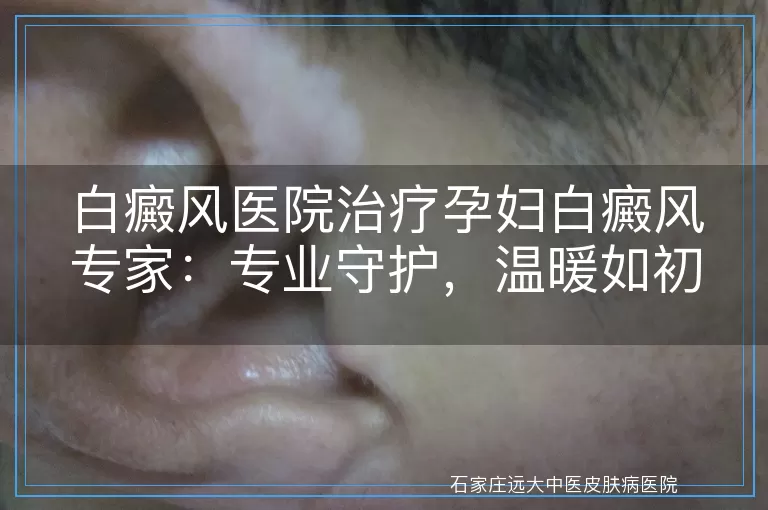 白癜风医院治疗孕妇白癜风专家：专业守护，温暖如初