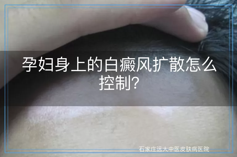 孕妇身上的白癜风扩散怎么控制？