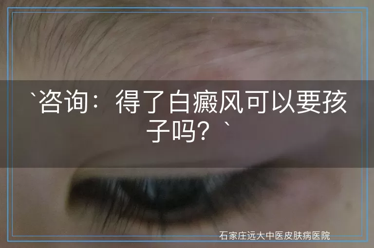咨询：得了白癜风可以要孩子吗？