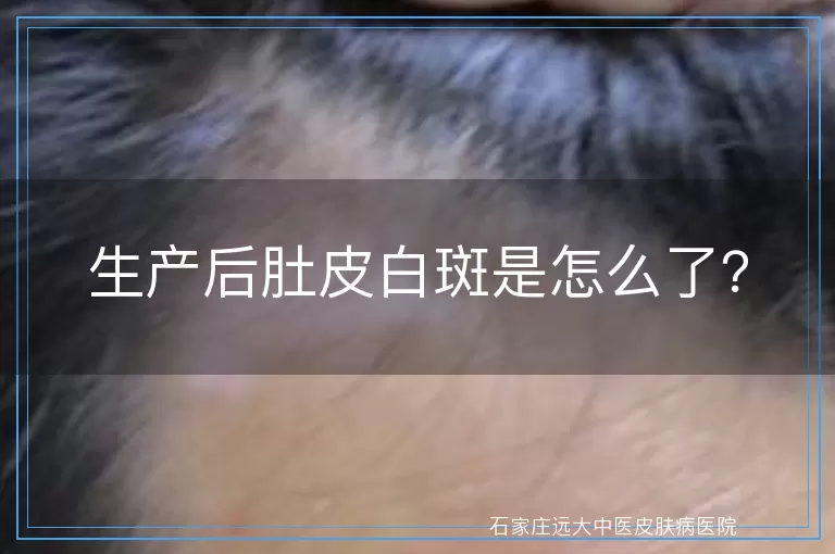生产后肚皮白斑是怎么了？