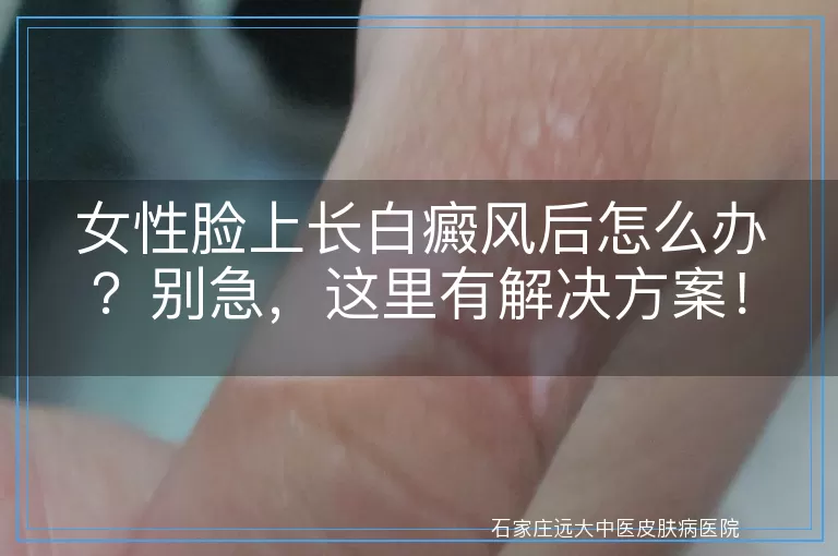 女性脸上长白癜风后怎么办？别急，这里有解决方案！