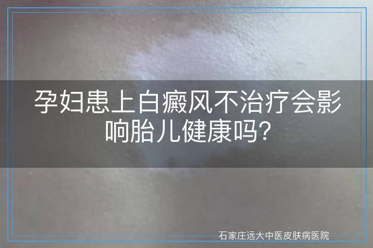 孕妇患上白癜风不治疗会影响胎儿健康吗？