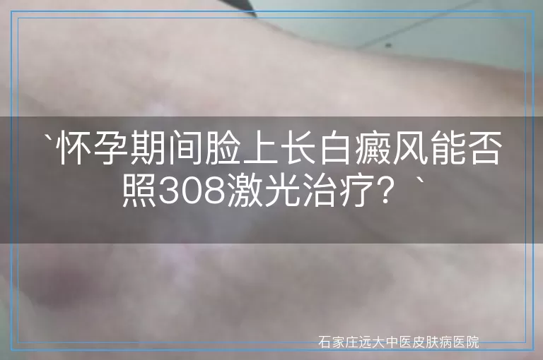 怀孕期间脸上长白癜风能否照308激光治疗？