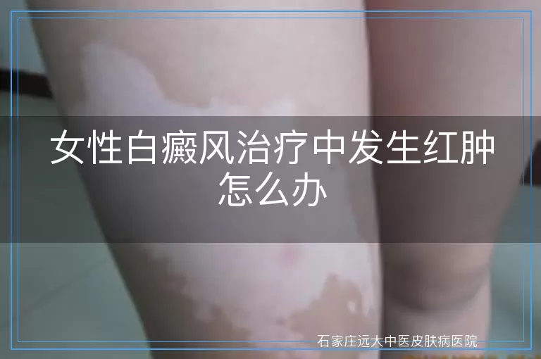 女性白癜风治疗中发生红肿怎么办