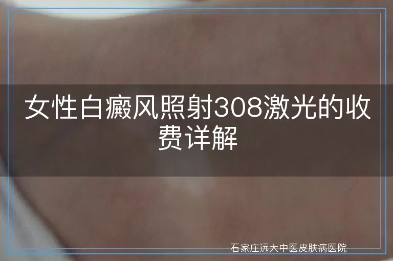 女性白癜风照射308激光的收费详解