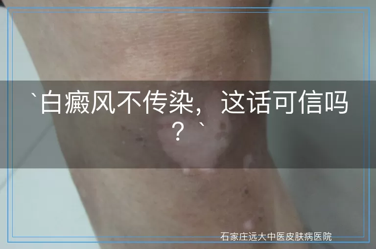 白癜风不传染，这话可信吗？