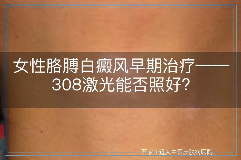 女性胳膊白癜风早期治疗——308激光能否照好？
