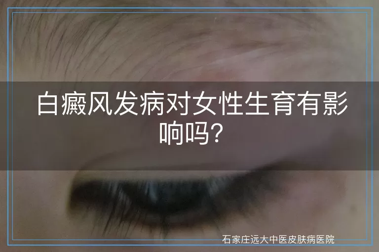 白癜风发病对女性生育有影响吗？