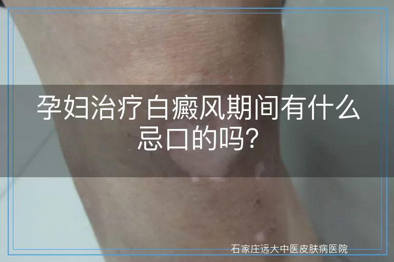 孕妇治疗白癜风期间有什么忌口的吗？