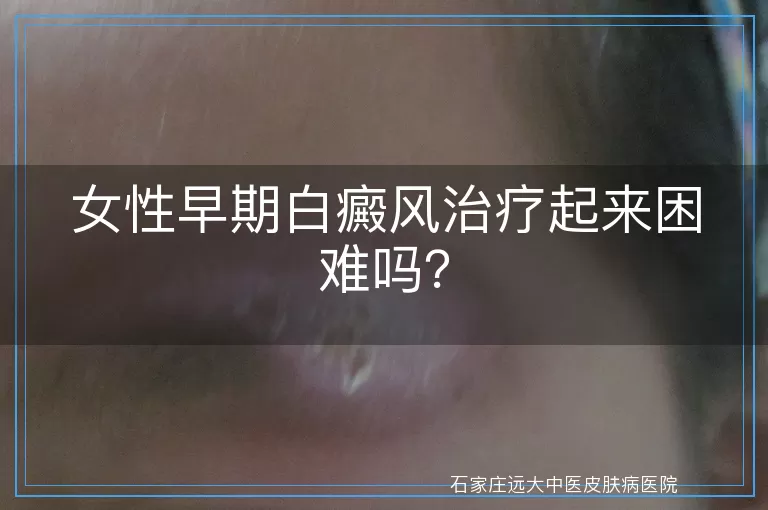 女性早期白癜风治疗起来困难吗？