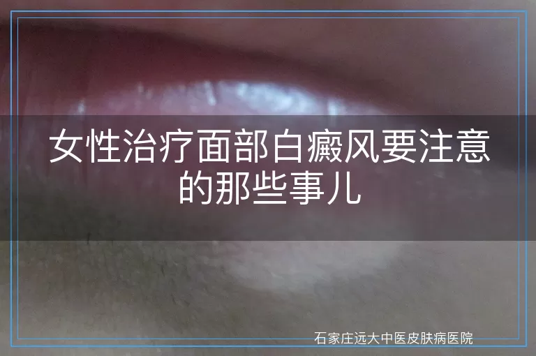 女性治疗面部白癜风要注意的那些事儿