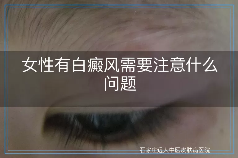 女性有白癜风需要注意什么问题