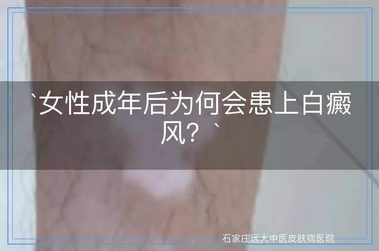 女性成年后为何会患上白癜风？