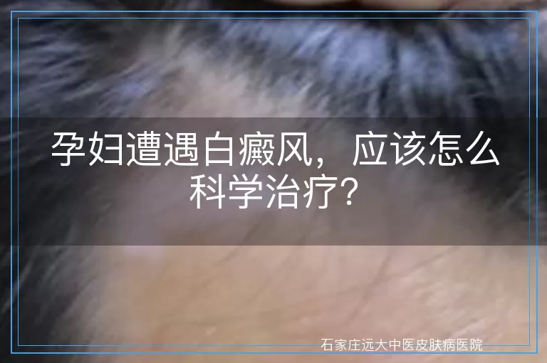 孕妇遭遇白癜风，应该怎么科学治疗？