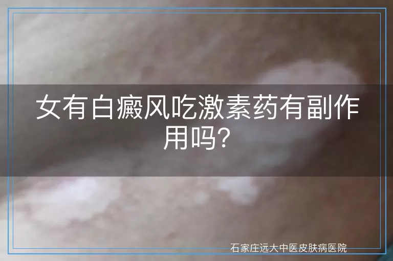 女有白癜风吃激素药有副作用吗？
