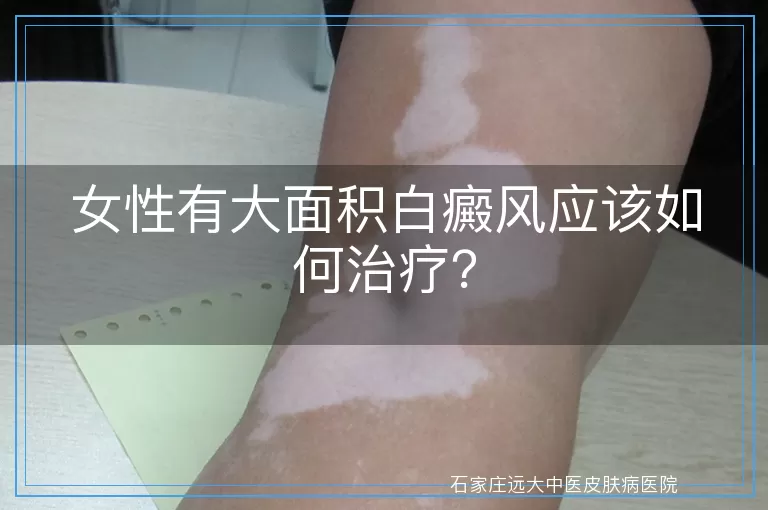 女性有大面积白癜风应该如何治疗？