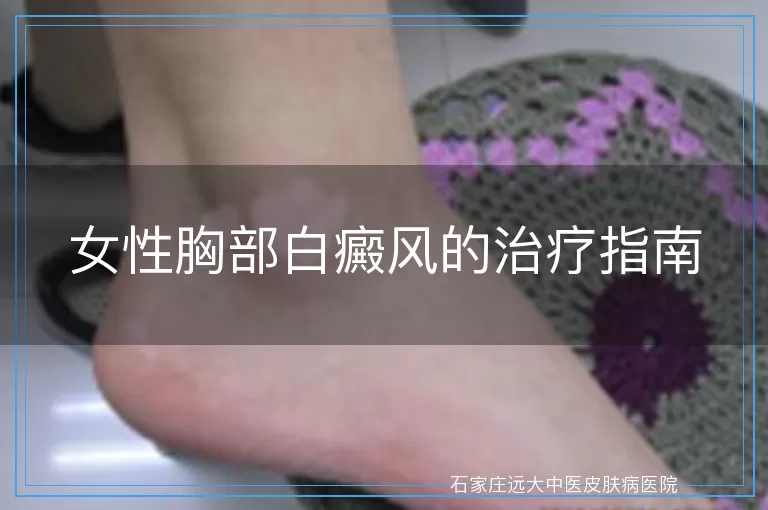 女性胸部白癜风的治疗指南
