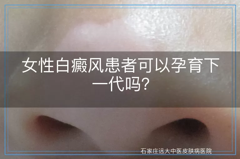 女性白癜风患者可以孕育下一代吗？