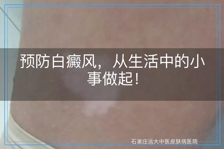 预防白癜风，从生活中的小事做起！