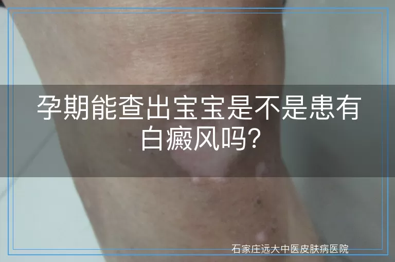 孕期能查出宝宝是不是患有白癜风吗？