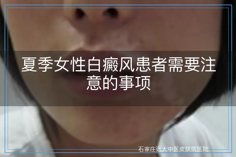 夏季女性白癜风患者需要注意的事项