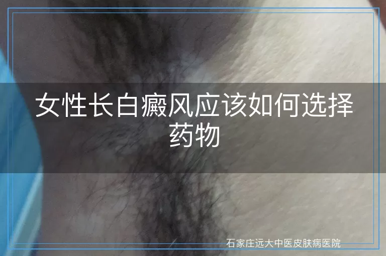 女性长白癜风应该如何选择药物