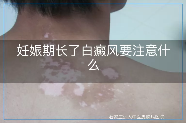 妊娠期长了白癜风要注意什么