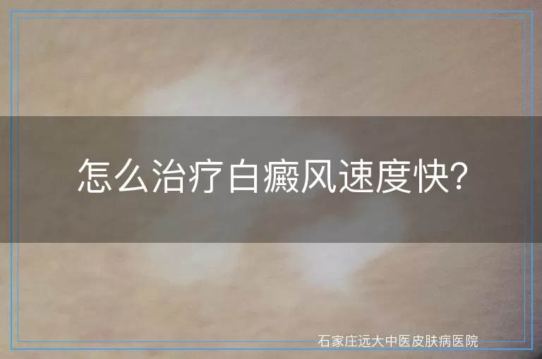 怎么治疗白癜风速度快？