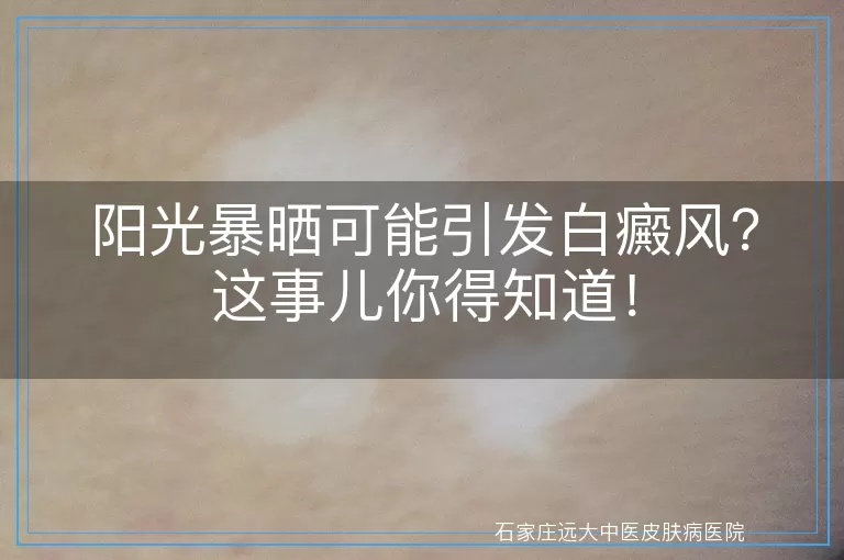 阳光暴晒可能引发白癜风？这事儿你得知道！