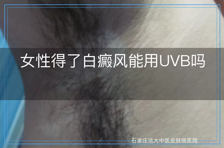 女性得了白癜风能用UVB吗