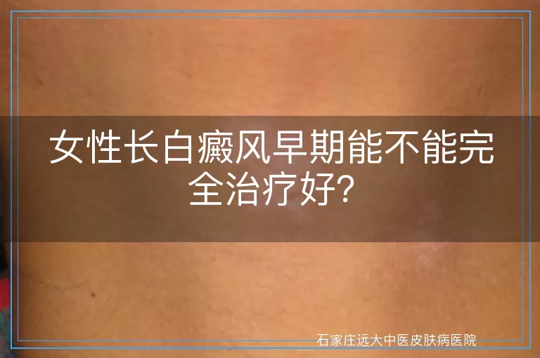 女性长白癜风早期能不能完全治疗好？