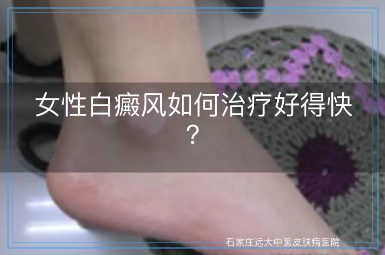 女性白癜风如何治疗好得快？