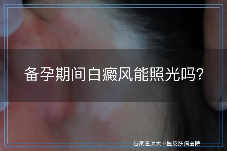 备孕期间白癜风能照光吗？