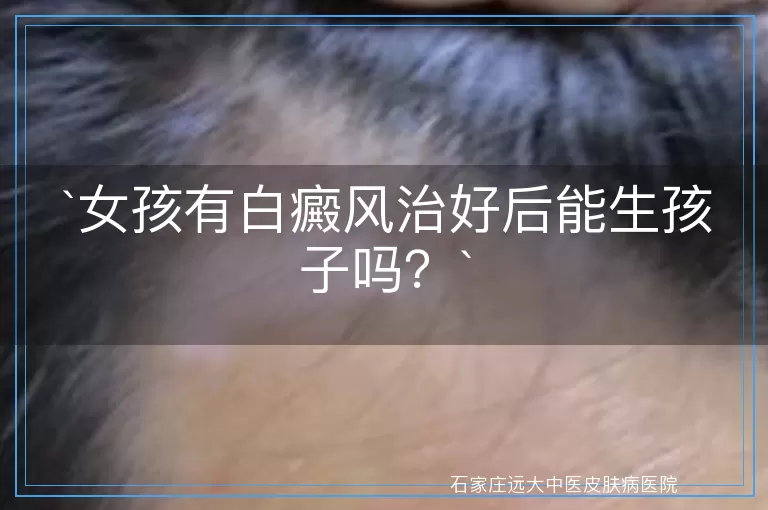 女孩有白癜风治好后能生孩子吗？