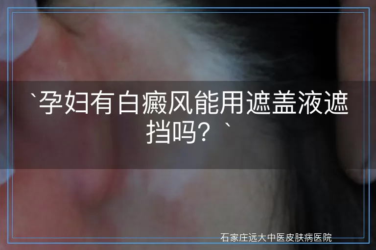 孕妇有白癜风能用遮盖液遮挡吗？