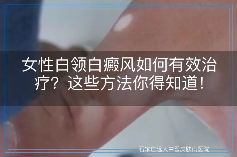 女性白领白癜风如何有效治疗？这些方法你得知道！