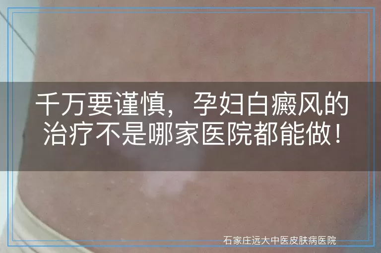 千万要谨慎，孕妇白癜风的治疗不是哪家医院都能做！