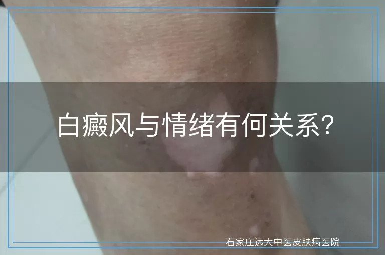 白癜风与情绪有何关系？