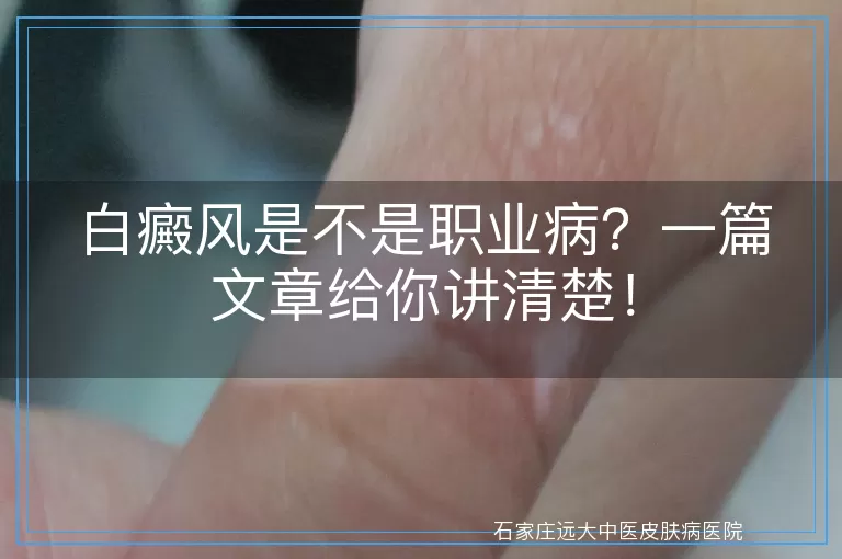 白癜风是不是职业病？一篇文章给你讲清楚！