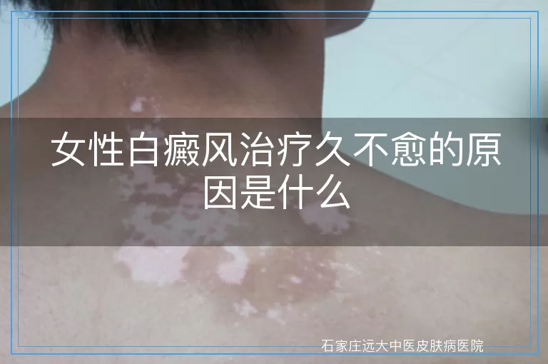 女性白癜风治疗久不愈的原因是什么