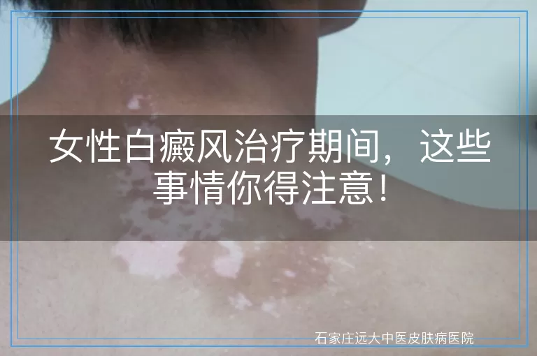 女性白癜风治疗期间，这些事情你得注意！