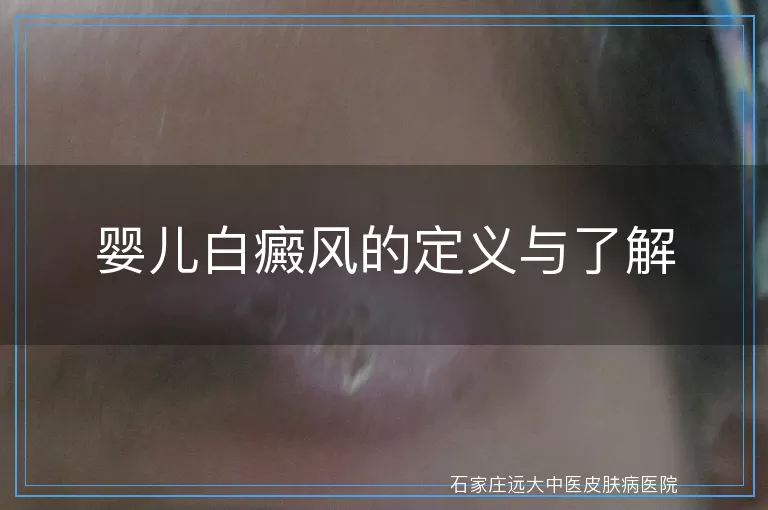 婴儿白癜风的定义与了解